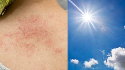 வெயில் அதிகம்? வேர்க்குரு இல்லை! இதை பாலோ பண்ணுங்க!