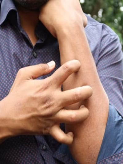 மழைக்காலத்தில் சருமத்தில் ஏன் அரிப்பு அதிகமாகிறது..?